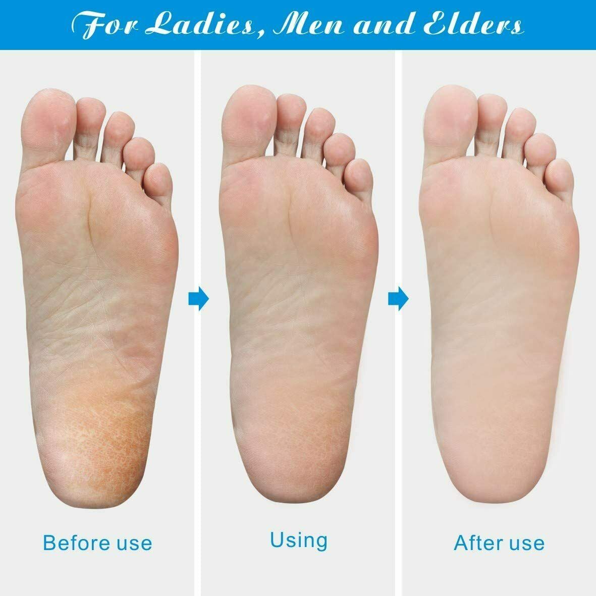 Professional Foot Callus Remover File Rasp Scraper Cracked Pedicure Rough Tool My Store